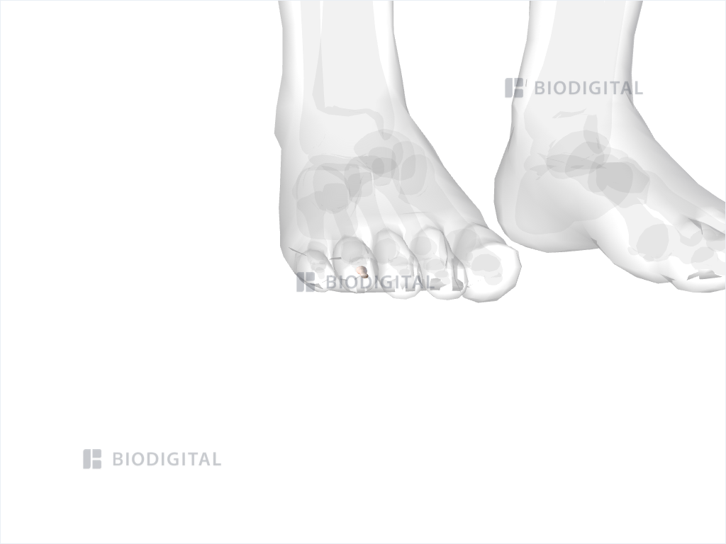 Distal phalanx of right fourth toe