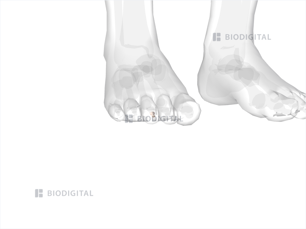 Distal phalanx of right third toe