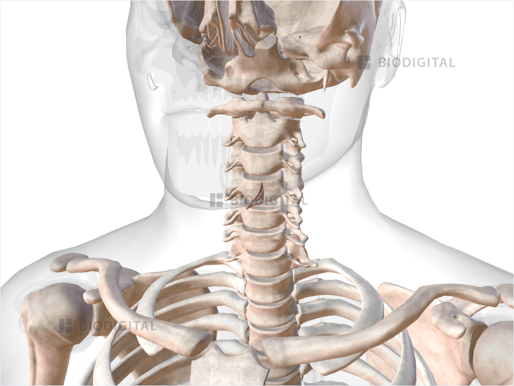 Left thyroarytenoid