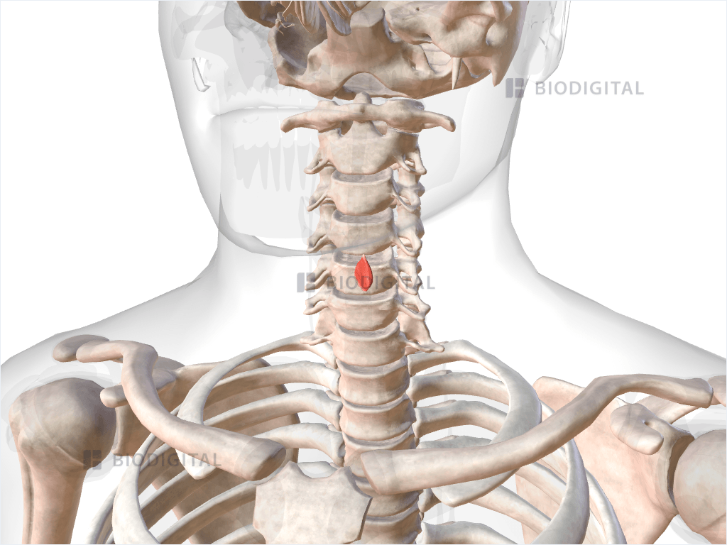 Left posterior cricoarytenoid