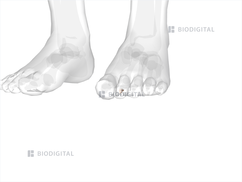 Distal phalanx of left second toe