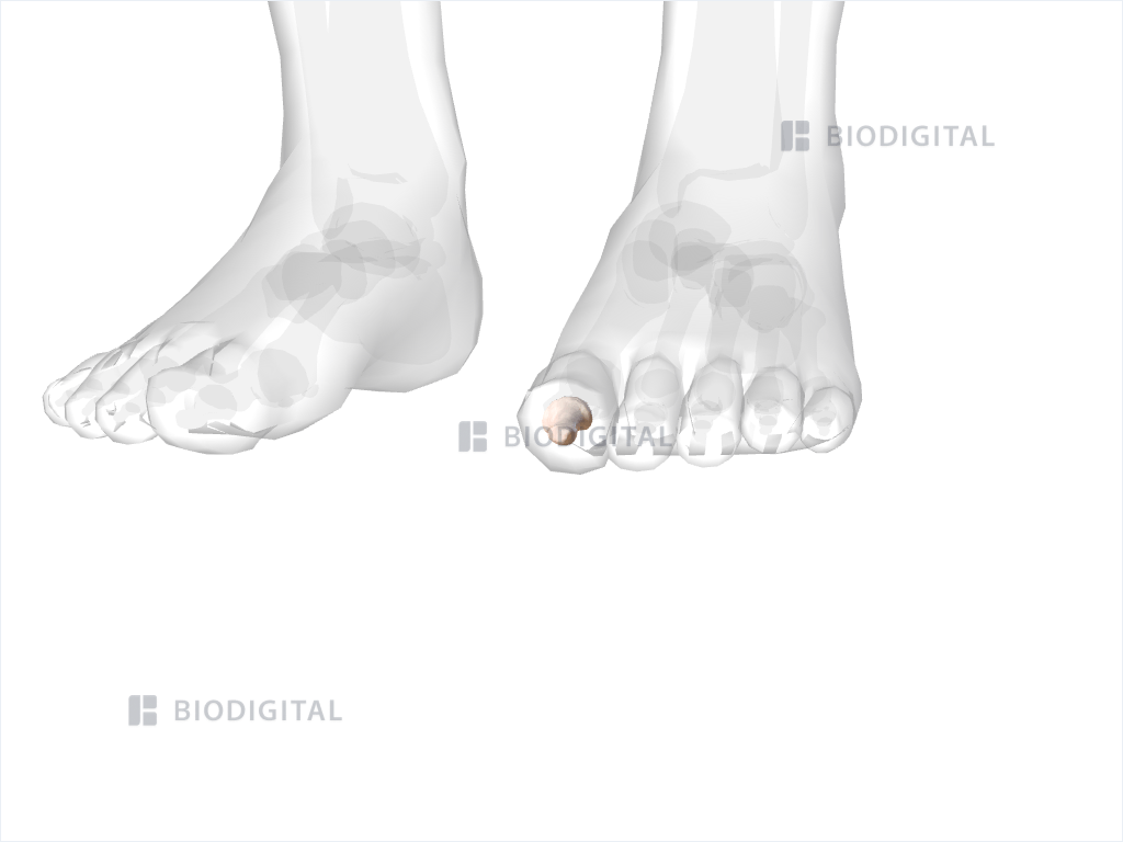 Distal phalanx of left big toe